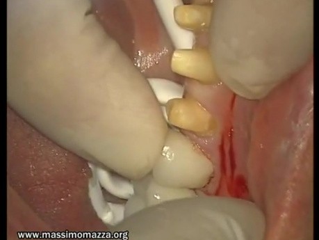 Best Way To Fix Crown - Adhesive Cementation (2/2)