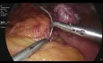 Mini Gastric Bypass + Nissen Fundoplication + Hiatus Hernia Repair