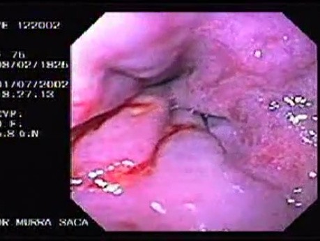 Hemorrhage due status post rubber band ligation of esophageal varices (11 of 25)