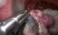 TAMIS ESD for Rectal Adenoma