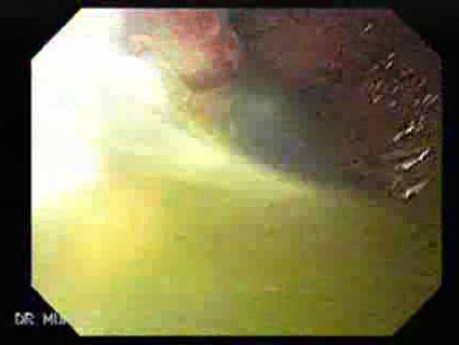 Ulcerated Hyperplastic Polyp (3 of 4)
