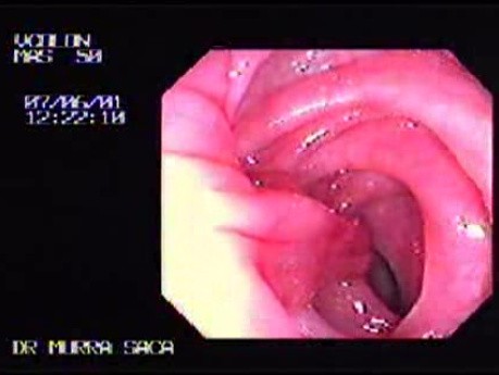 Pediculated Villotubular Adenoma (2 of 2)
