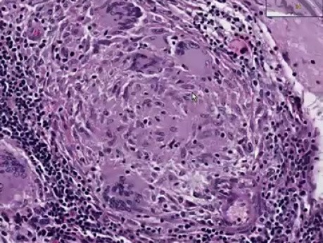 Sarcoidosis - Brain, cerebellum - Histopathology