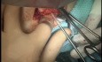 Complex Distal Humerus Fracture in Pediatric Patient