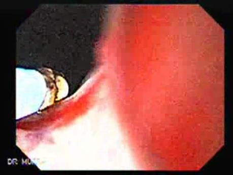 Alcoholic Cirrhosis - Coagulation of Site of the Bleeding in Esophagus