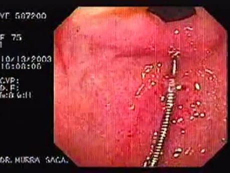 Esophageal Achalasia  (5 of 16)