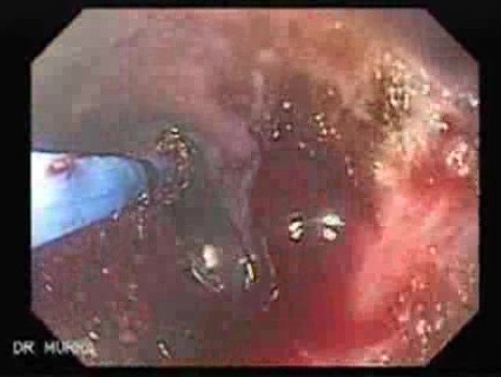 Severe Bleeding of the Upper Digestive System After Two Days of Band Ligation - Use of Argon Plasma Coagulator to Stop The Bleeding
