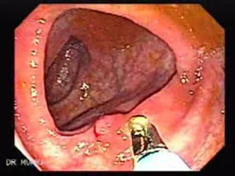 Colitis Ulcerosa - Pseudopolyps (9 of 22)