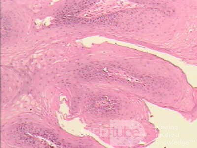 Endoscopy of Esophageal Papilloma (3 of 4)