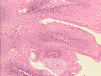Endoscopy of Esophageal Papilloma (3 of 4)
