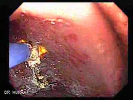 Gastric Antral Vascular Ectasias - GAVE (5 of 6)