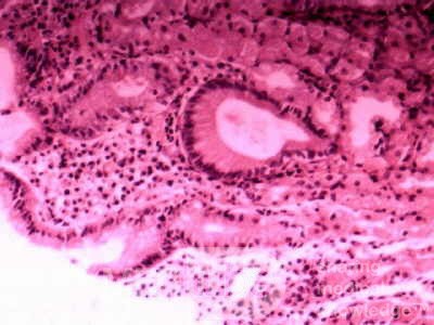 Trichuris Trichuris (whipworm) (9 of 10)