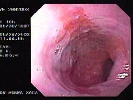 Barret´s Esophagus long segment -106-year-old female patient (1 of 4)