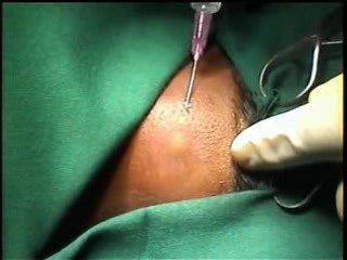 Neck Space Infections- Surgical Drainage Of The Abscess