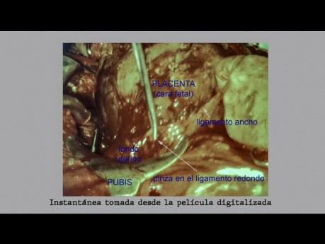 Ended Ectopic Abdominal Pregnancy