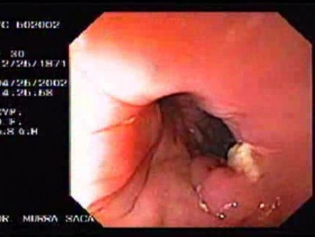 Full Colonoscopy (1 of 4)