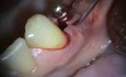 Implant Microsurgery: Periimplant Repair of Implant Overdenture Abutment