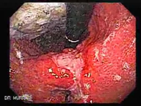Adenocarcinoma of the Gastric Antrum That Infiltrates The Lesser Curvature (1 of 3)