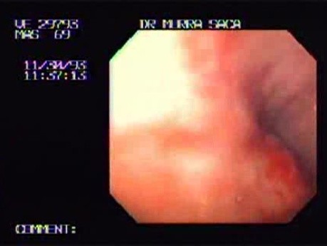 Squamous Cell Carcinoma of the Cardias - Ulceration and Bleeding