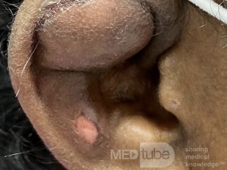 Traumatic Auricular Hematoma