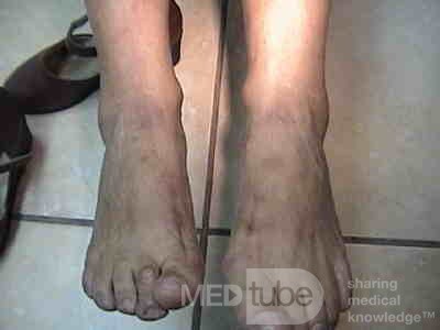 Extensive Acanthosis Nigricans due to rectal carcinoma (4 of 7)