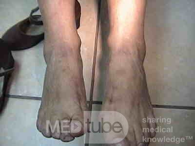 Extensive Acanthosis Nigricans due to rectal carcinoma (4 of 7)