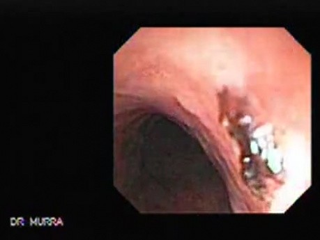 Traqueostomy Fistula (4 of 5)