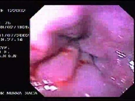 Hemorrhage Due Status Post Rubber Band Ligation of Esophageal Varices - Retraction Post Injection