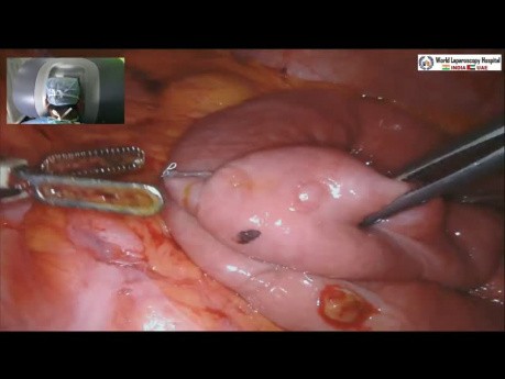 Robotic Roux-en-Y Hepaticojejunostomy in a Post-cholecystectomy Bile Duct Injury