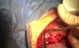 Tetralogy or TF with Absent Pulmonary Valve and Mega Pulmonary Artery