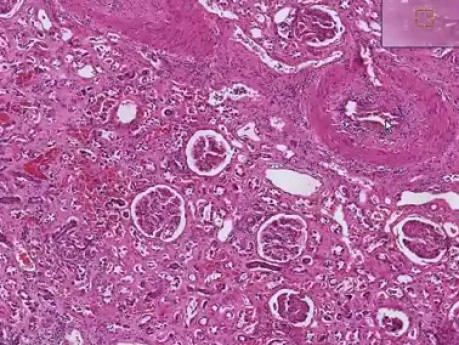 Chronic transplant rejection - Histopathology - Kidney