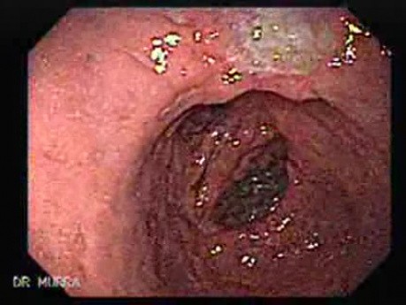 Gatsric Adenocarcinoma of the Lesser Curvature After Gastrectomy Billroth II (2 of 3)