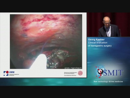 Clinical Evaluation of Transgastric Surgery - SMIT 2019
