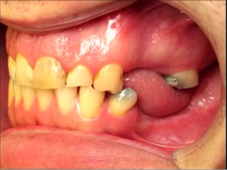 MS - Treatment Overview