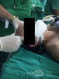 Endoscopic Third Ventriculostomy in a Benign Case of Aicardi Syndrome with Obstructive Hydrocephalus and Chiari Malformation type 1