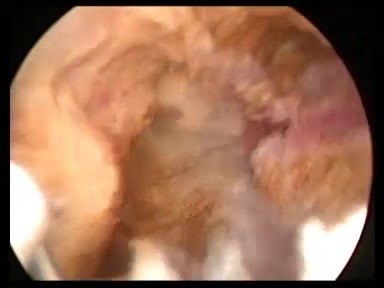 Histeroscopic resection of adenomyosis