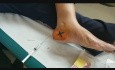 How to Make a Calcaneal Esporao Infiltration? My Personal Method.