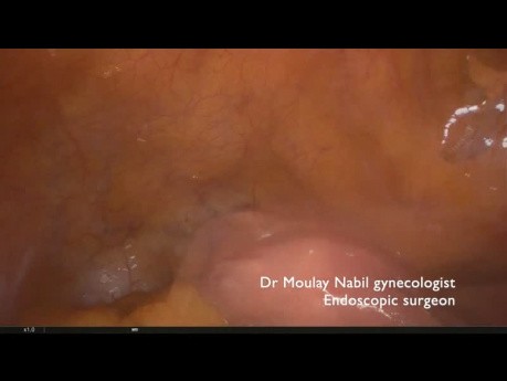 Adnexal Necrosis in Postmenopausal Woman
