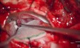 MVD for Hemifacial Spasm