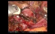Selective Pelvic Lymphadenectomy