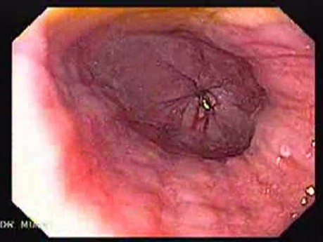 Gastrointestinal Stromal Tumors - Reflux Esophagitis