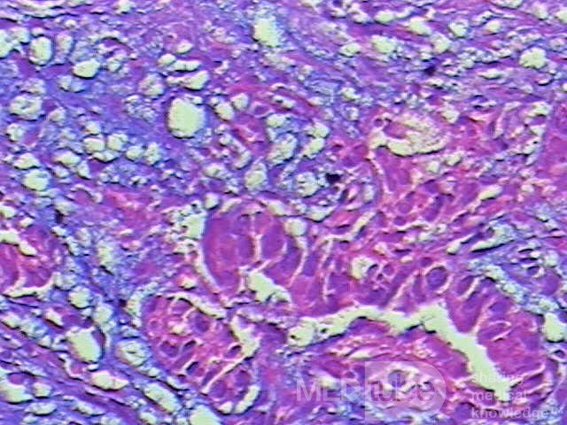 Barrett Adenocarcinoma - Endoscopic Image  (7 of 20)