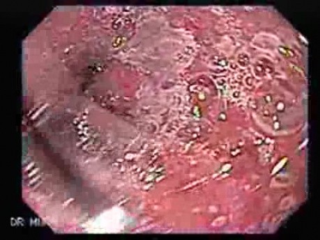 Barrett's Esophagus of long segment - residual islans of the squamous epithelium (5 of 24)