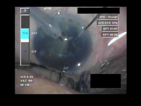 Cataract Surgery V - Part 3
