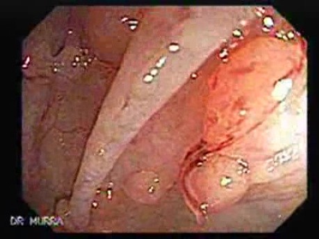 Familial Adenomatous Polyposis (8 of 36)