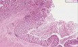 Adenocarcinoma - Histopathology - Colon