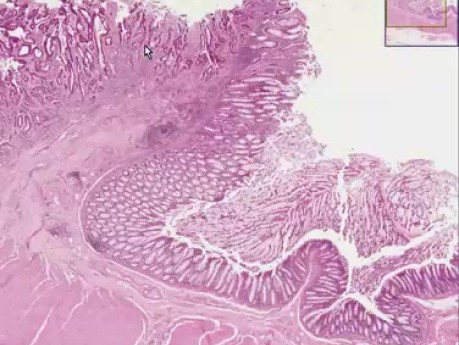 Adenocarcinoma - Histopathology - Colon