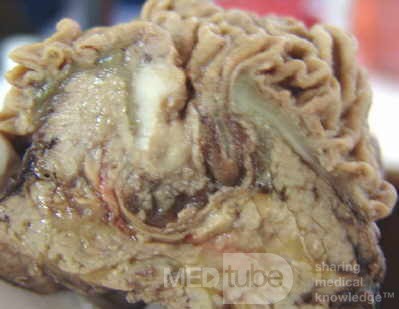 Cholangiocarcinoma that infiltrated a Periampullary Duodenal Diverticula and the head of the pancreas (14 of 20)