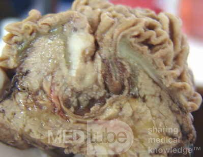 Cholangiocarcinoma that infiltrated a Periampullary Duodenal Diverticula and the head of the pancreas (14 of 20)