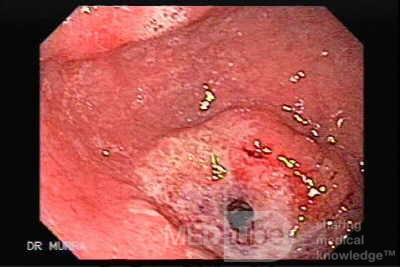 Gastric Ulcerated Adenocarcinoma of the Pre-pyloric Antrum (3 of 28)